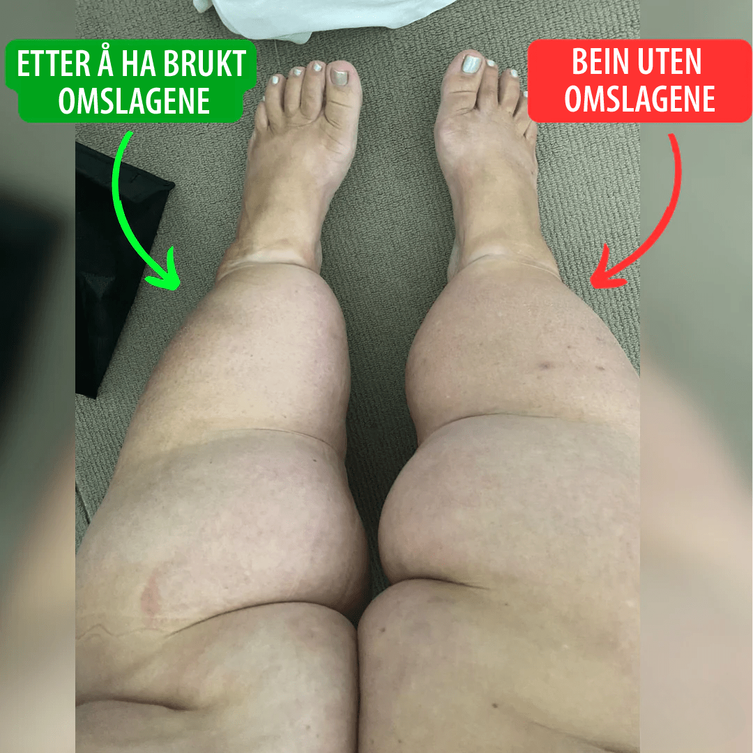 Kalkkompresjonsinnpakning - NordHjem